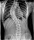 Scoliosis Rehabilitation