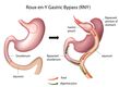 Gastric Bypass