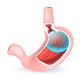 Gastric Balloon