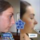 Rhinoplasty