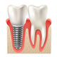 Implant treatment