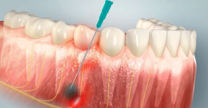 Infiltration Anesthesia
