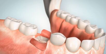 Implant lateral tooth