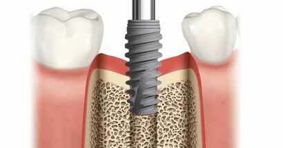 Implant Placement In The Posterior Region