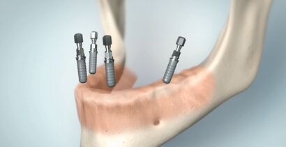 All-on-4 Implant