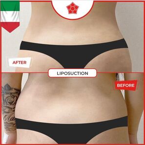 638260543564898576liposuction3.jpg